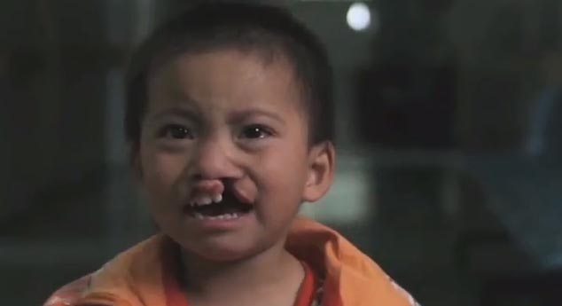 Cleft1.jpg