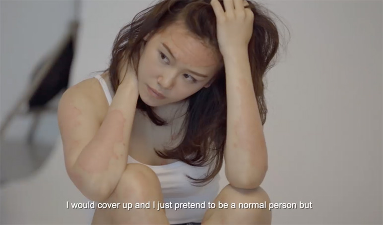 Psoriasis_3.jpg