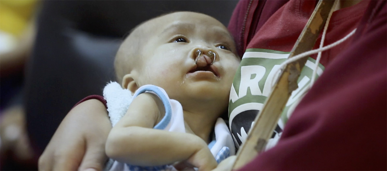 Thanonchai Sornsriwichai films the story of a man born with a cleft lip in moving BBDO Bangkok campaign for Operation Smile