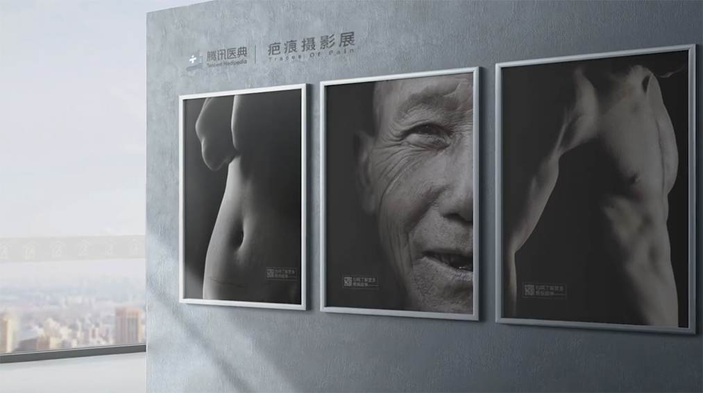 Tencent Shenzhen launches digital photography exhibition ‘Traces of Pain’ telling the struggles of mutilation and scars patients